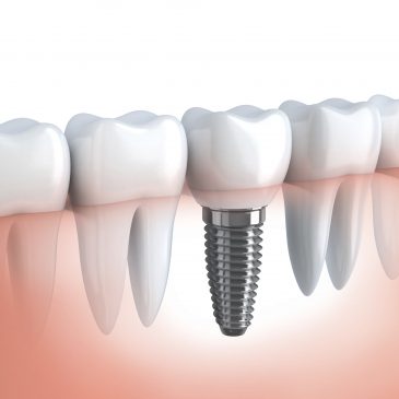 Top 7 Reasons to Opt for Dental Implants – Austell, GA